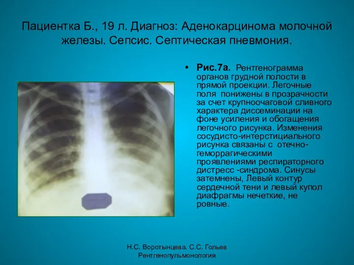 Н.С. Воротынцева. С.С. Гольев Рентгенопульмонология Пациентка Б., 19 л. Диагноз: Аденокарцинома