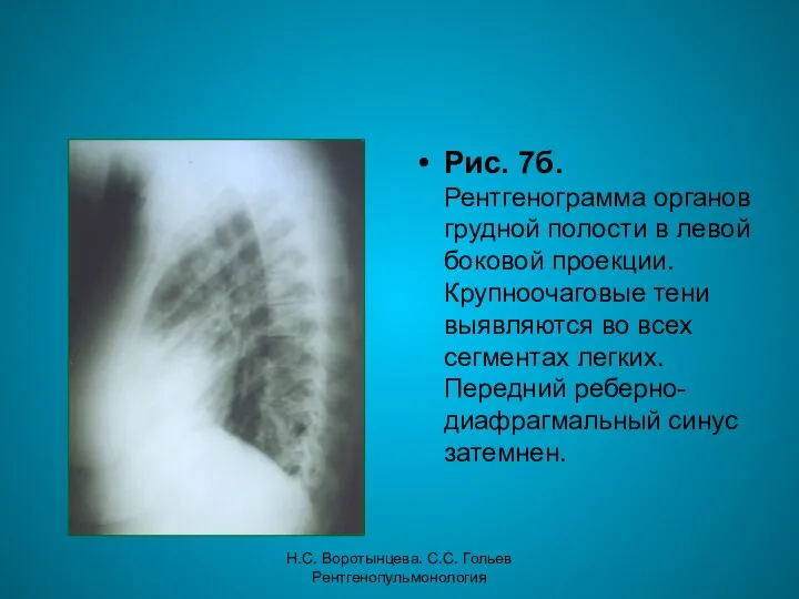 Н.С. Воротынцева. С.С. Гольев Рентгенопульмонология Рис. 7б. Рентгенограмма органов грудной полости