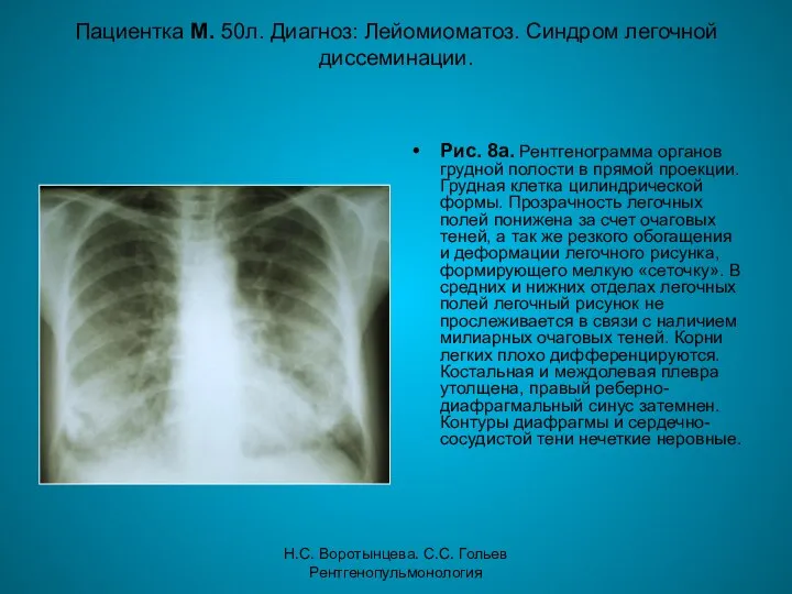 Н.С. Воротынцева. С.С. Гольев Рентгенопульмонология Пациентка М. 50л. Диагноз: Лейомиоматоз. Синдром