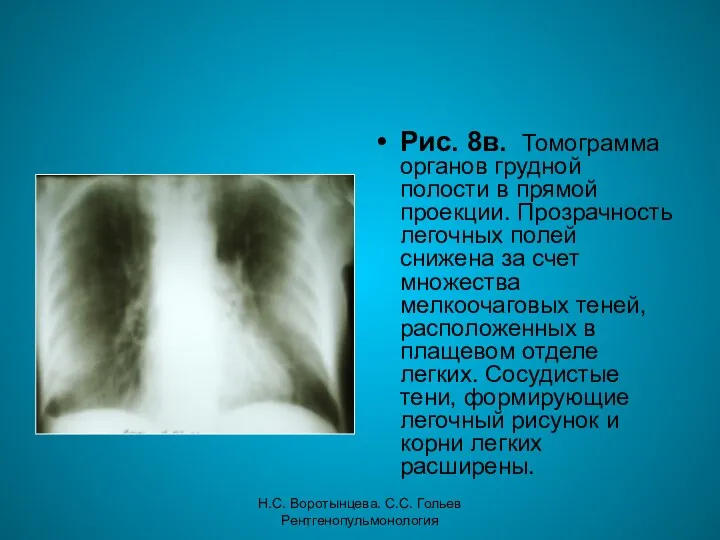 Н.С. Воротынцева. С.С. Гольев Рентгенопульмонология Рис. 8в. Томограмма органов грудной полости