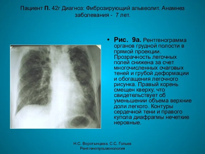 Н.С. Воротынцева. С.С. Гольев Рентгенопульмонология Пациент П. 42г Диагноз: Фиброзирующий альвеолит.