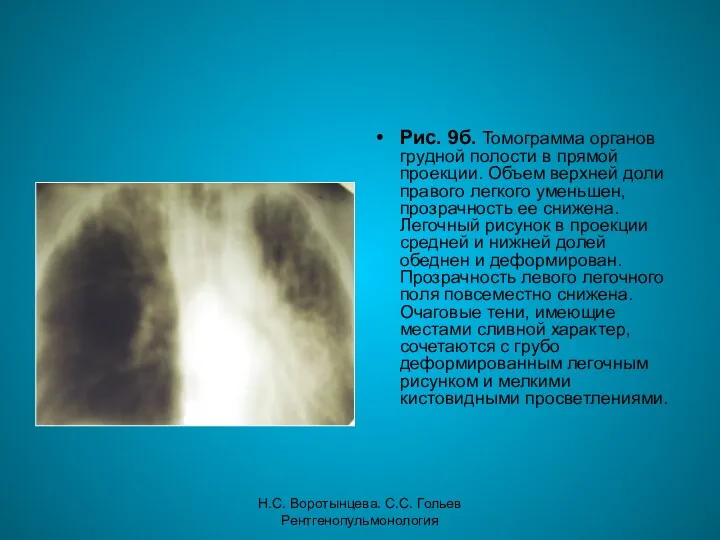Н.С. Воротынцева. С.С. Гольев Рентгенопульмонология Рис. 9б. Томограмма органов грудной полости