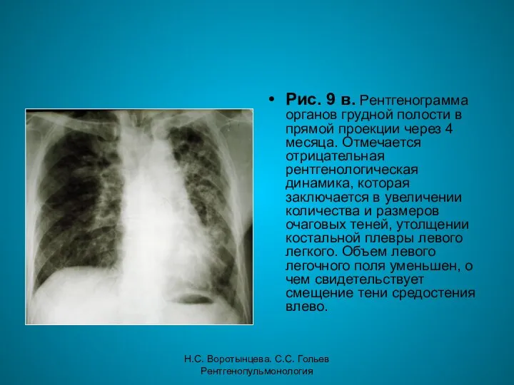 Н.С. Воротынцева. С.С. Гольев Рентгенопульмонология Рис. 9 в. Рентгенограмма органов грудной