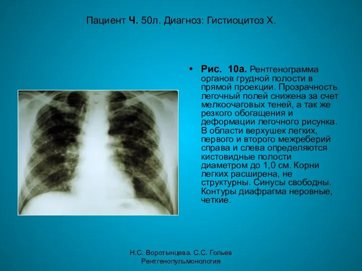 Н.С. Воротынцева. С.С. Гольев Рентгенопульмонология Пациент Ч. 50л. Диагноз: Гистиоцитоз Х.