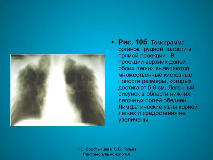 Н.С. Воротынцева. С.С. Гольев Рентгенопульмонология Рис. 10б .Томограмма органов грудной полости