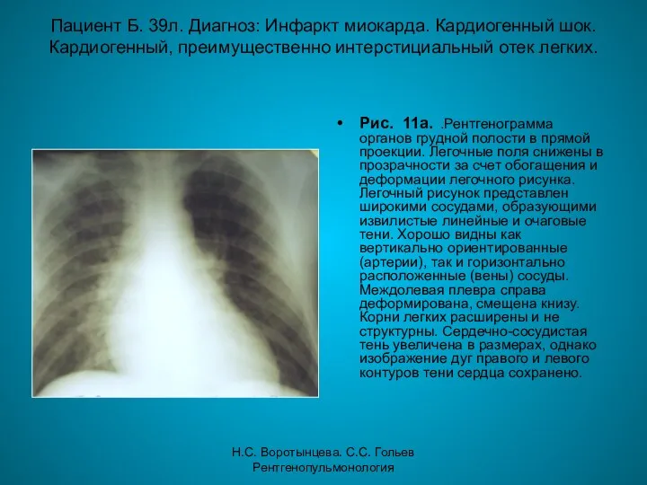 Н.С. Воротынцева. С.С. Гольев Рентгенопульмонология Пациент Б. 39л. Диагноз: Инфаркт миокарда.