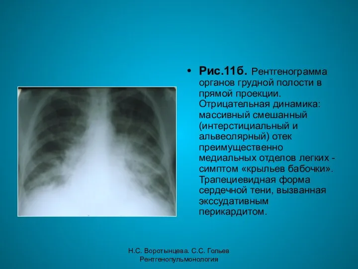 Н.С. Воротынцева. С.С. Гольев Рентгенопульмонология Рис.11б. Рентгенограмма органов грудной полости в