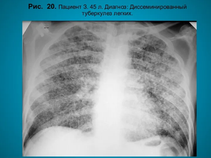 Н.С. Воротынцева. С.С. Гольев Рентгенопульмонология Рис. 20. Пациент З. 45 л. Диагноз: Диссеминированный туберкулез легких.