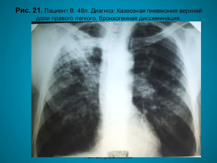 Н.С. Воротынцева. С.С. Гольев Рентгенопульмонология Рис. 21. Пациент В. 48л. Диагноз: