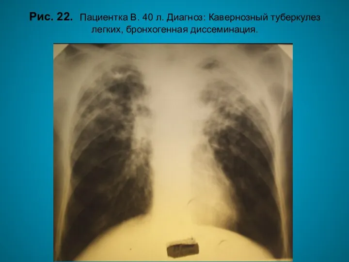 Н.С. Воротынцева. С.С. Гольев Рентгенопульмонология Рис. 22. Пациентка В. 40 л.