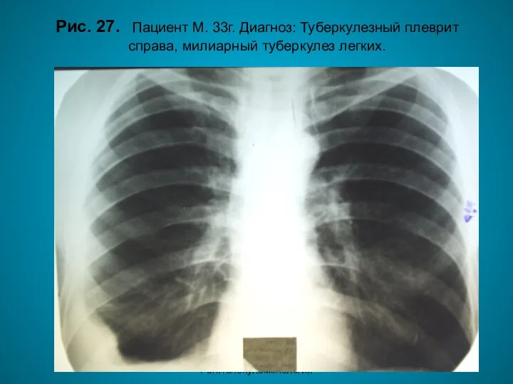 Н.С. Воротынцева. С.С. Гольев Рентгенопульмонология Рис. 27. Пациент М. 33г. Диагноз: