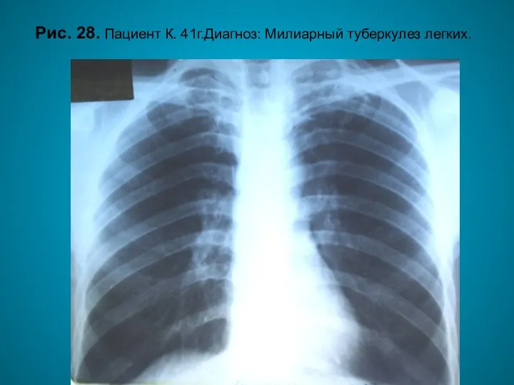 Н.С. Воротынцева. С.С. Гольев Рентгенопульмонология Рис. 28. Пациент К. 41г.Диагноз: Милиарный туберкулез легких.