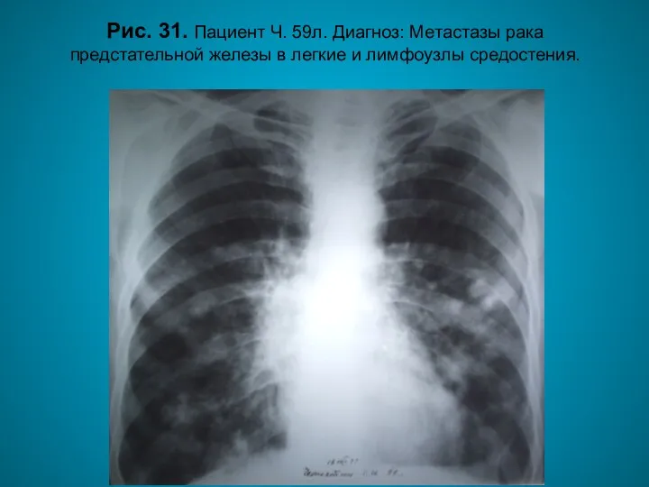 Н.С. Воротынцева. С.С. Гольев Рентгенопульмонология Рис. 31. Пациент Ч. 59л. Диагноз: