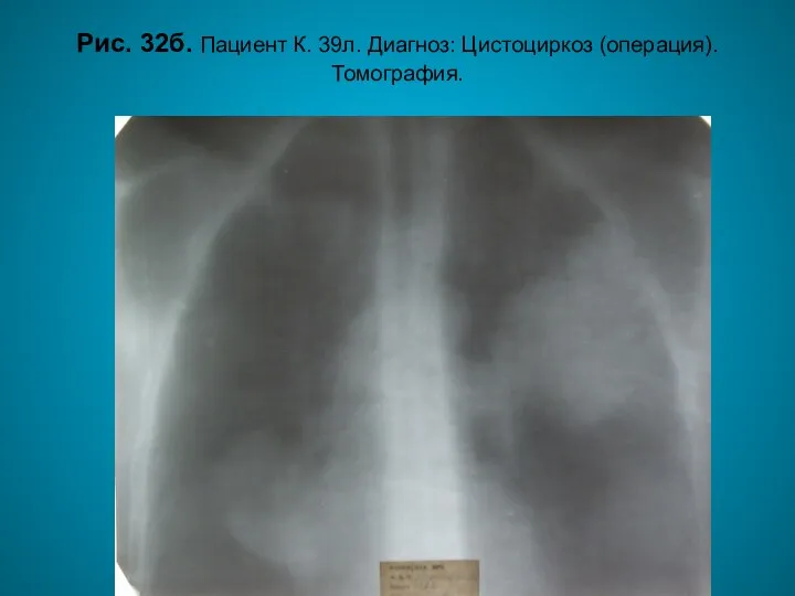 Н.С. Воротынцева. С.С. Гольев Рентгенопульмонология Рис. 32б. Пациент К. 39л. Диагноз: Цистоциркоз (операция). Томография.