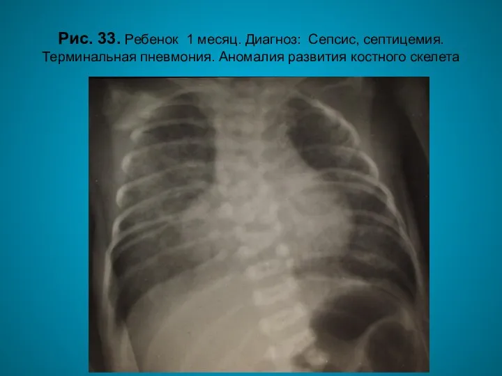 Н.С. Воротынцева. С.С. Гольев Рентгенопульмонология Рис. 33. Ребенок 1 месяц. Диагноз: