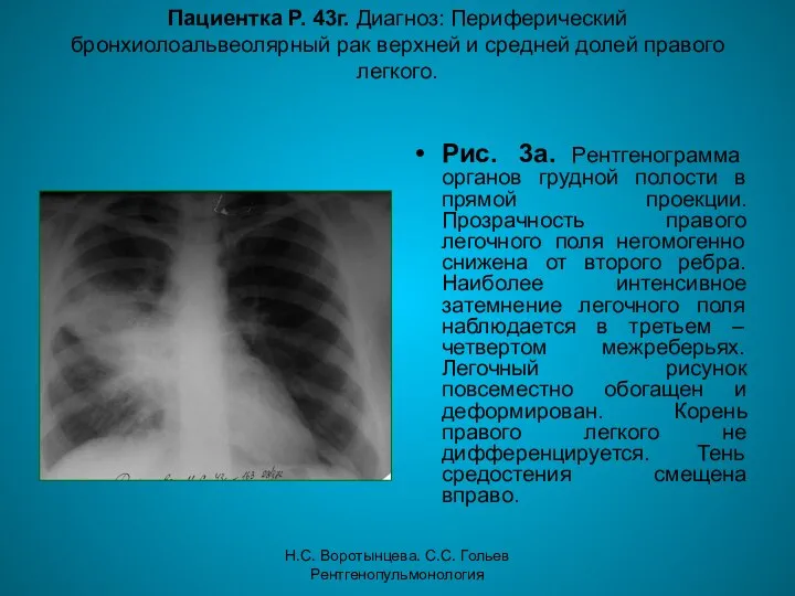 Н.С. Воротынцева. С.С. Гольев Рентгенопульмонология Пациентка Р. 43г. Диагноз: Периферический бронхиолоальвеолярный