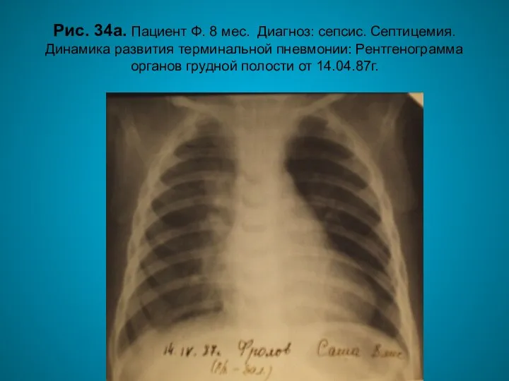 Н.С. Воротынцева. С.С. Гольев Рентгенопульмонология Рис. 34а. Пациент Ф. 8 мес.