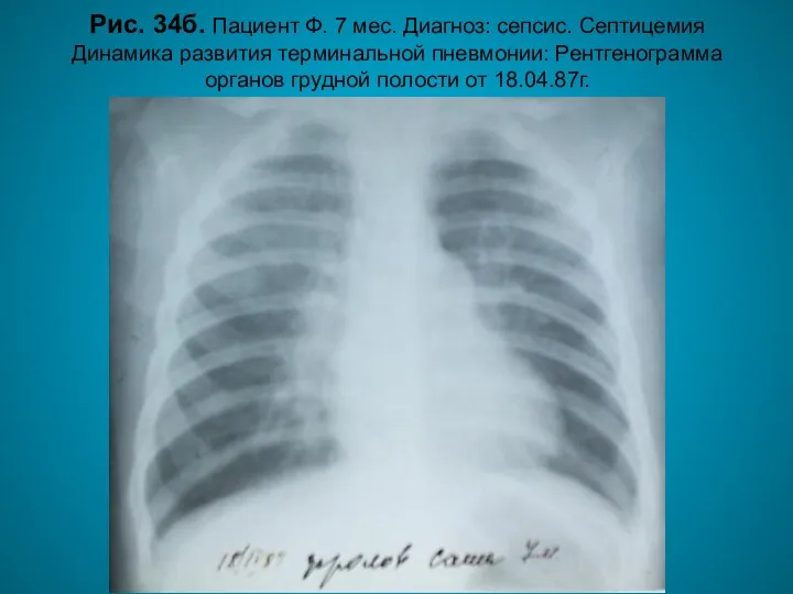 Н.С. Воротынцева. С.С. Гольев Рентгенопульмонология Рис. 34б. Пациент Ф. 7 мес.
