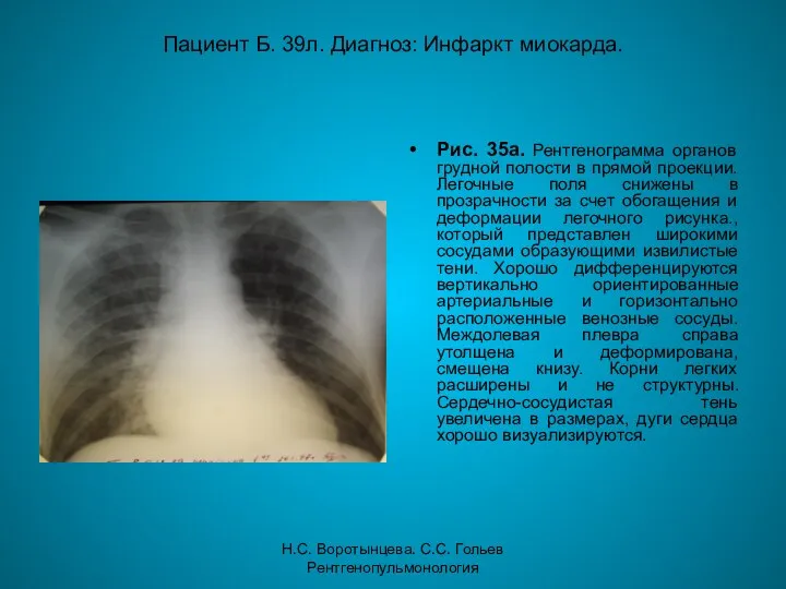 Н.С. Воротынцева. С.С. Гольев Рентгенопульмонология Пациент Б. 39л. Диагноз: Инфаркт миокарда.