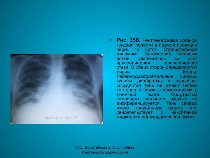 Н.С. Воротынцева. С.С. Гольев Рентгенопульмонология Рис. 35б. Рентгенограмма органов грудной полости