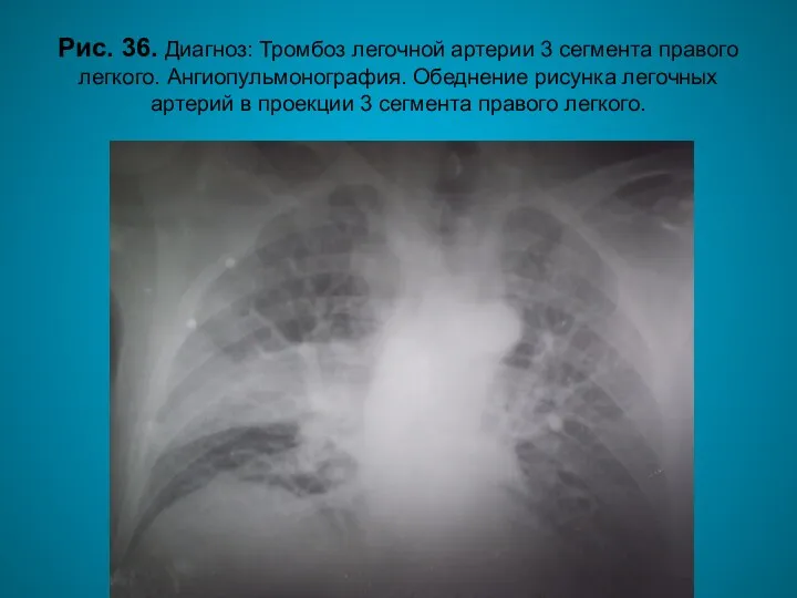 Н.С. Воротынцева. С.С. Гольев Рентгенопульмонология Рис. 36. Диагноз: Тромбоз легочной артерии