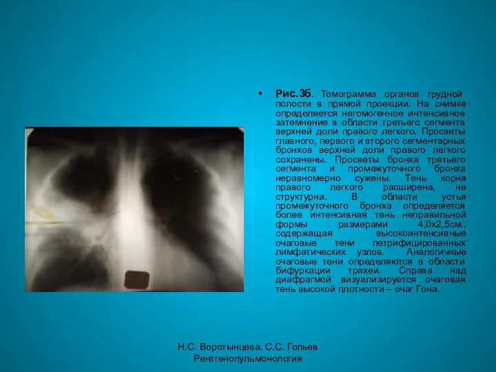 Н.С. Воротынцева. С.С. Гольев Рентгенопульмонология Рис.3б. Томограмма органов грудной полости в