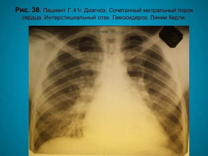 Н.С. Воротынцева. С.С. Гольев Рентгенопульмонология Рис. 38. Пациент Г. 41г. Диагноз: