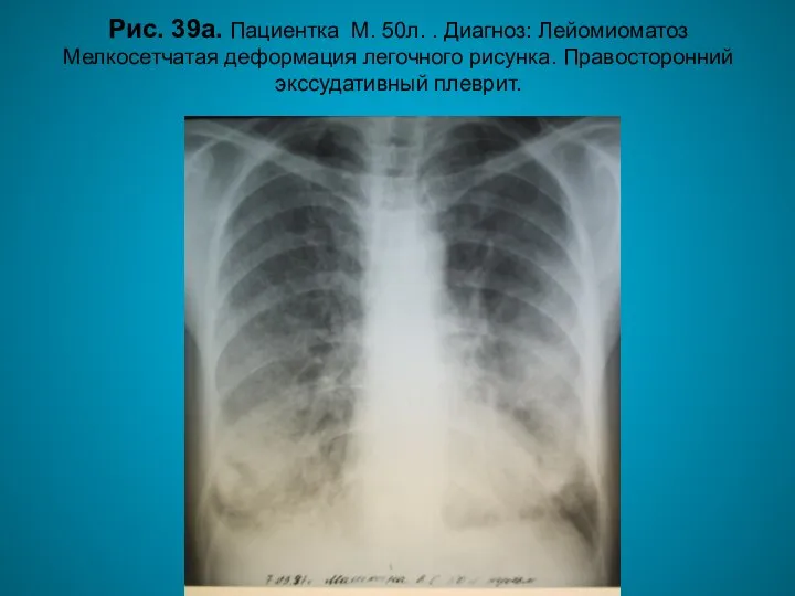 Н.С. Воротынцева. С.С. Гольев Рентгенопульмонология Рис. 39а. Пациентка М. 50л. .