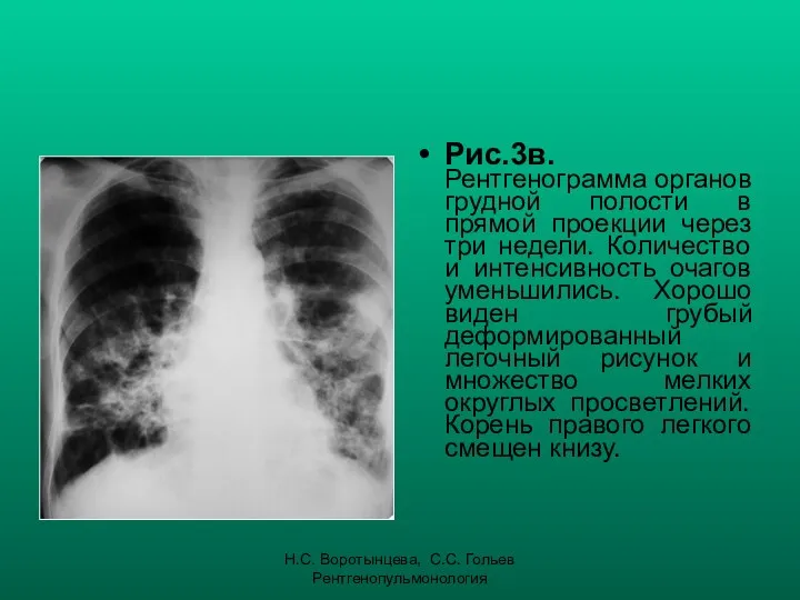 Н.С. Воротынцева, С.С. Гольев Рентгенопульмонология Рис.3в. Рентгенограмма органов грудной полости в