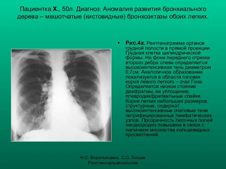 Н.С. Воротынцева, С.С. Гольев Рентгенопульмонология Пациентка Х., 50л. Диагноз: Аномалия развития