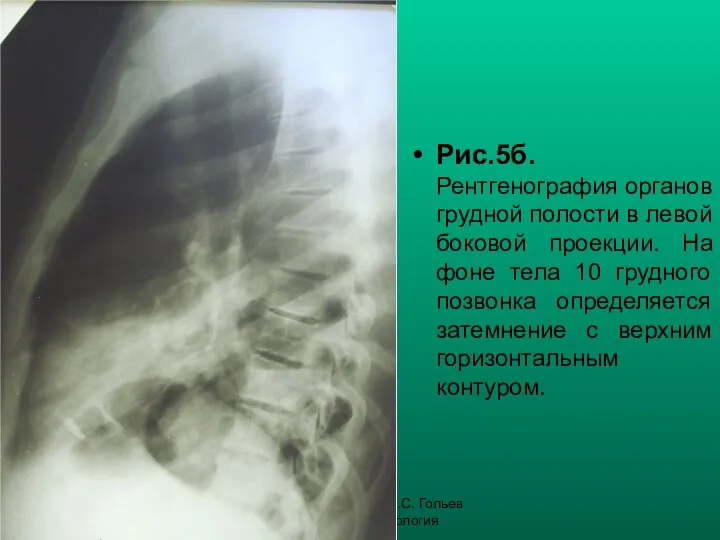 Н.С. Воротынцева, С.С. Гольев Рентгенопульмонология Рис.5б. Рентгенография органов грудной полости в