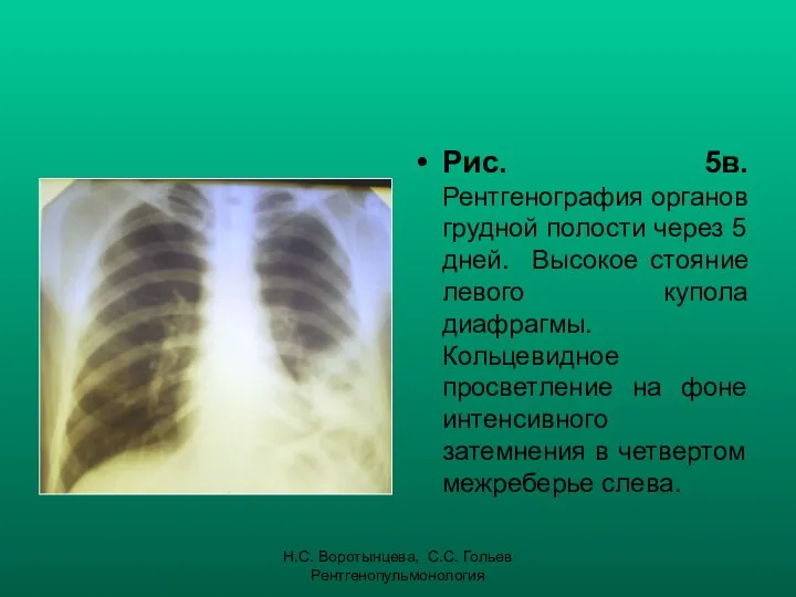 Н.С. Воротынцева, С.С. Гольев Рентгенопульмонология Рис. 5в. Рентгенография органов грудной полости