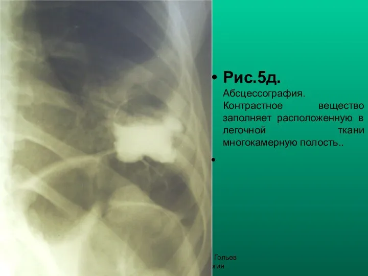 Н.С. Воротынцева, С.С. Гольев Рентгенопульмонология Рис.5д. Абсцессография. Контрастное вещество заполняет расположенную в легочной ткани многокамерную полость..