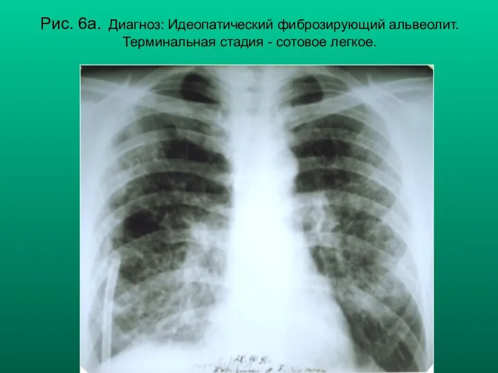 Н.С. Воротынцева, С.С. Гольев Рентгенопульмонология Рис. 6а. Диагноз: Идеопатический фиброзирующий альвеолит. Терминальная стадия - сотовое легкое.