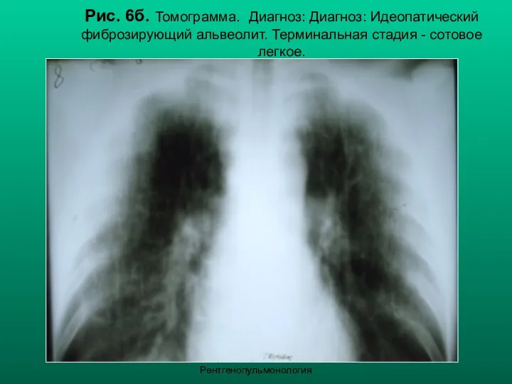 Н.С. Воротынцева, С.С. Гольев Рентгенопульмонология Рис. 6б. Томограмма. Диагноз: Диагноз: Идеопатический