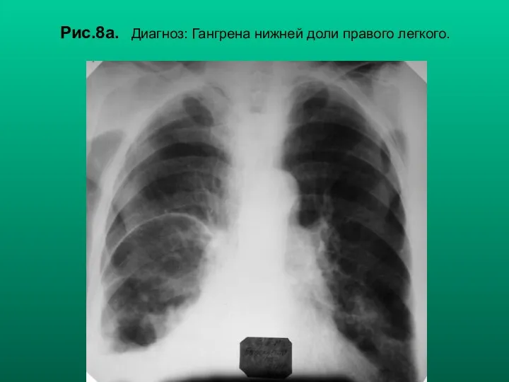 Н.С. Воротынцева, С.С. Гольев Рентгенопульмонология Рис.8а. Диагноз: Гангрена нижней доли правого легкого.