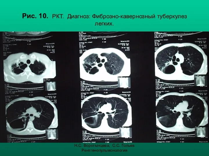 Н.С. Воротынцева, С.С. Гольев Рентгенопульмонология Рис. 10. РКТ. Диагноз: Фиброзно-кавернозный туберкулез легких.