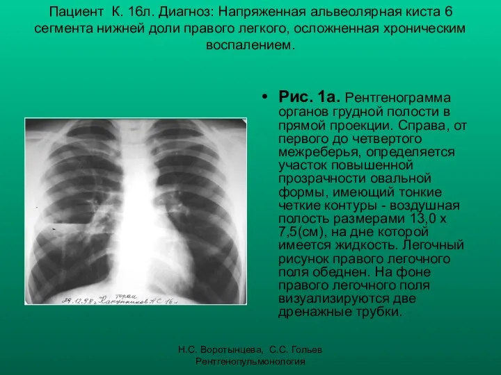 Н.С. Воротынцева, С.С. Гольев Рентгенопульмонология Пациент К. 16л. Диагноз: Напряженная альвеолярная
