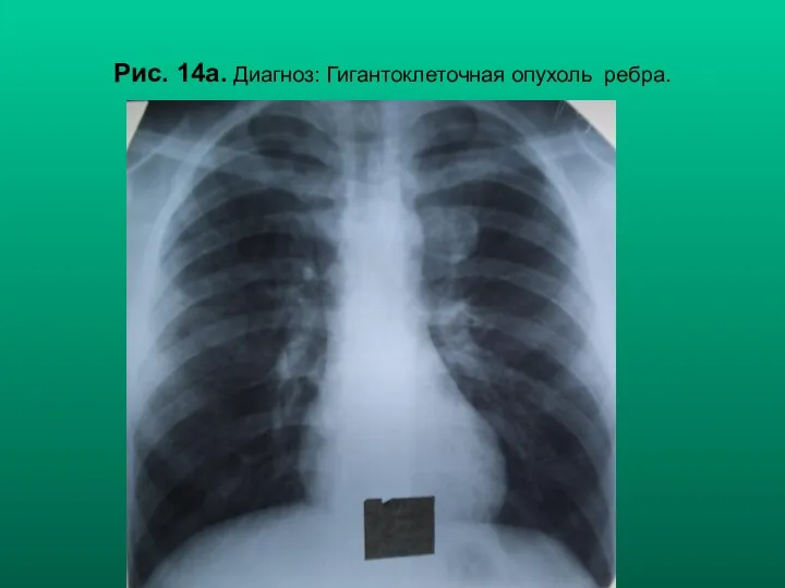 Н.С. Воротынцева, С.С. Гольев Рентгенопульмонология Рис. 14а. Диагноз: Гигантоклеточная опухоль ребра.