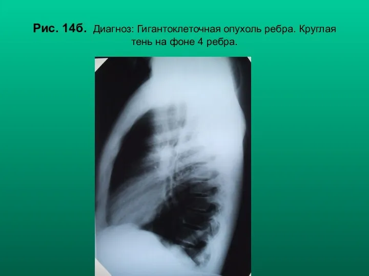 Н.С. Воротынцева, С.С. Гольев Рентгенопульмонология Рис. 14б. Диагноз: Гигантоклеточная опухоль ребра.