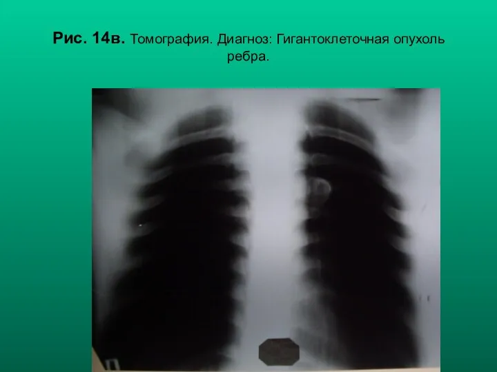 Н.С. Воротынцева, С.С. Гольев Рентгенопульмонология Рис. 14в. Томография. Диагноз: Гигантоклеточная опухоль ребра.