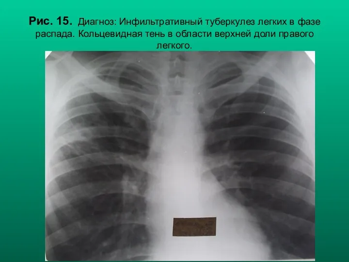 Н.С. Воротынцева, С.С. Гольев Рентгенопульмонология Рис. 15. Диагноз: Инфильтративный туберкулез легких