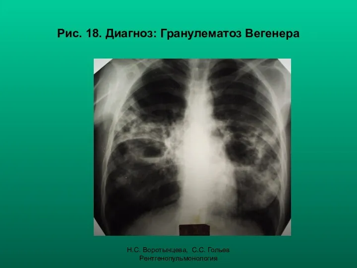 Н.С. Воротынцева, С.С. Гольев Рентгенопульмонология Рис. 18. Диагноз: Гранулематоз Вегенера