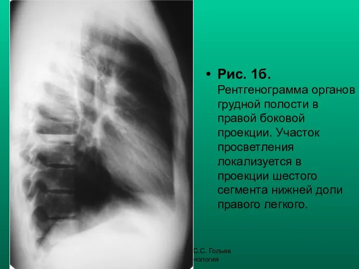 Н.С. Воротынцева, С.С. Гольев Рентгенопульмонология Рис. 1б. Рентгенограмма органов грудной полости