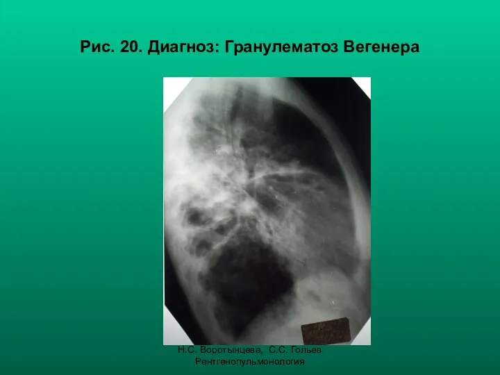 Н.С. Воротынцева, С.С. Гольев Рентгенопульмонология Рис. 20. Диагноз: Гранулематоз Вегенера