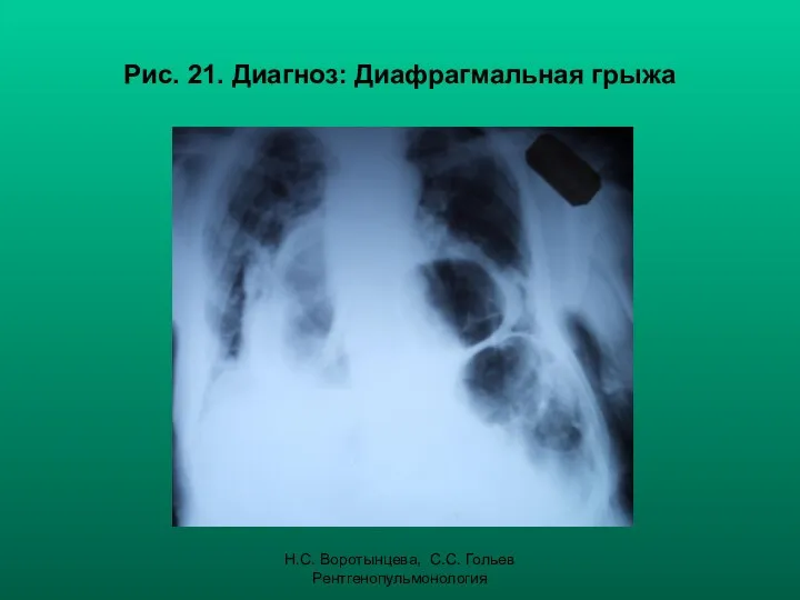 Н.С. Воротынцева, С.С. Гольев Рентгенопульмонология Рис. 21. Диагноз: Диафрагмальная грыжа