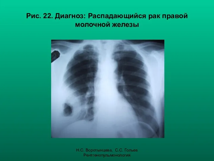 Н.С. Воротынцева, С.С. Гольев Рентгенопульмонология Рис. 22. Диагноз: Распадающийся рак правой молочной железы