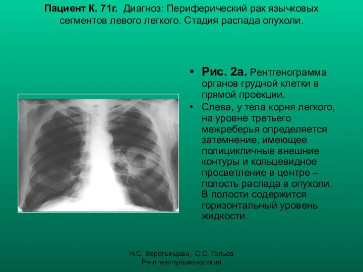 Н.С. Воротынцева, С.С. Гольев Рентгенопульмонология Пациент К. 71г. Диагноз: Периферический рак
