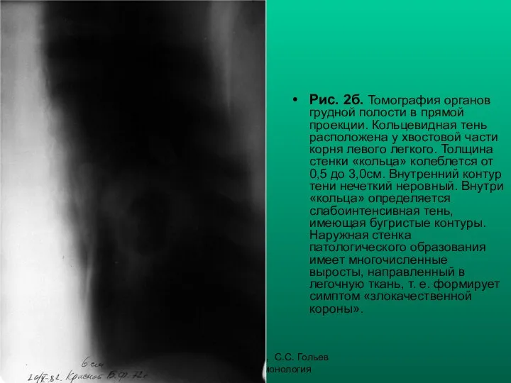 Н.С. Воротынцева, С.С. Гольев Рентгенопульмонология Рис. 2б. Томография органов грудной полости