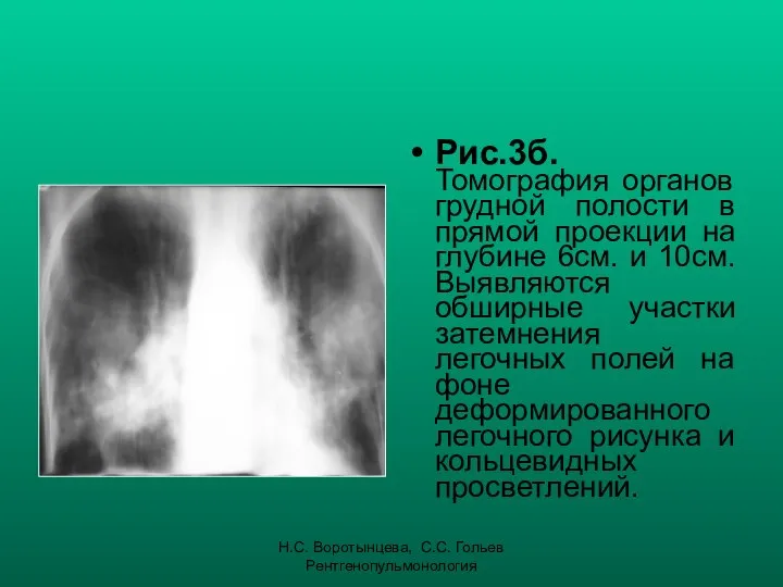 Н.С. Воротынцева, С.С. Гольев Рентгенопульмонология Рис.3б. Томография органов грудной полости в